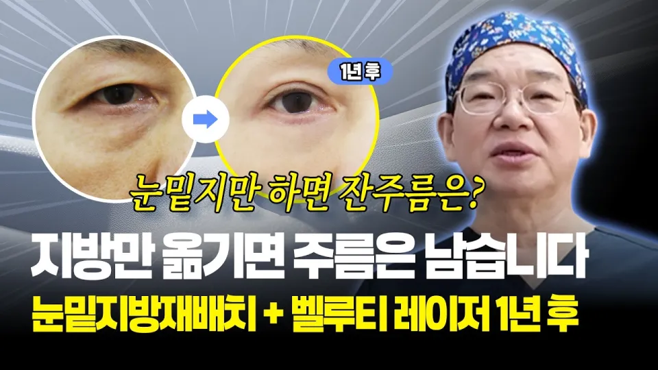 눈밑지방재배치만 했다면 잔주름은 남았을 겁니다 | 벨루티 레이저 동시 진행 1년 경과 | 보니따의원 눈성형